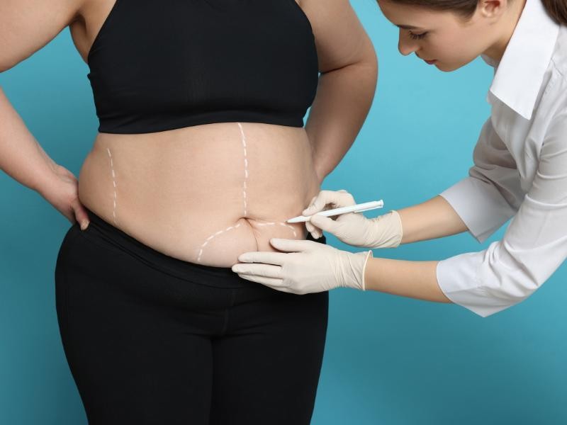 Cirurgia bariátrica e cirurgia reparadora pós-bariátrica: quando o plano de saúde é obrigado a custear?