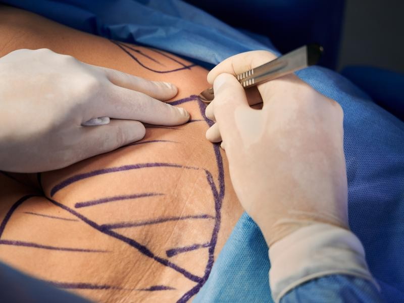 Cirurgia Bariátrica e Reparadora